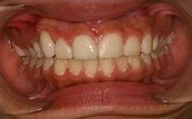 before and after of white fillings 2.0.2