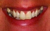 before and after veneers 12.1.1