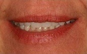 before and after veneers 14.1.2