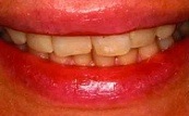 before and after veneers 15.1.1