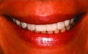 before and after veneers 15.1.2