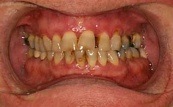 before and after veneers and crowns 3.5.1